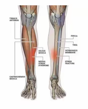 案例23  胫骨内侧应力综合征（附带治疗视频）