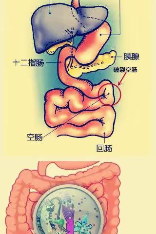 菏泽市第二人民医院行腹腔镜下空肠破裂修补术