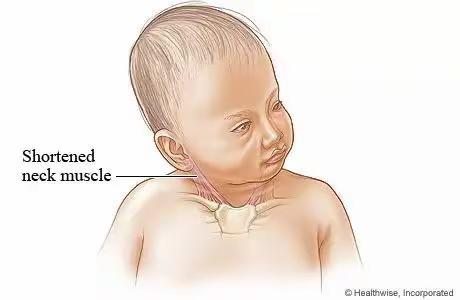 小儿斜颈——令无数孩子变丑、无数父母崩溃的疾病到底该怎么治？