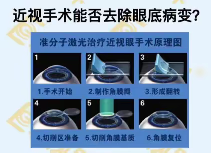 近视手术能否去除眼底病变？