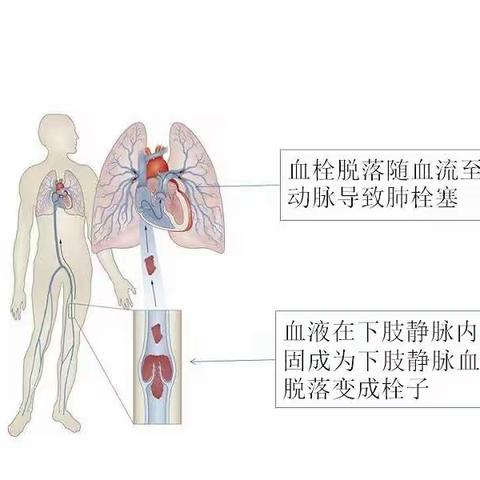 什么是静脉血栓？如何预防！