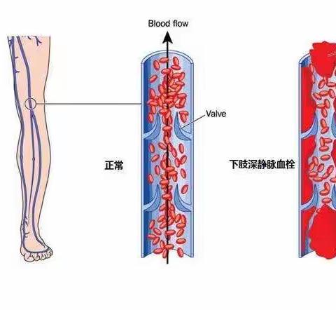 深静脉血栓—沉默的杀手