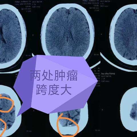 大跨度两个部位肿瘤，一个切口一次切除