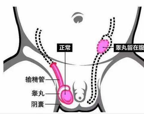 小儿隐睾症---宁夏回族自治区人民医院小儿外科健康宣教