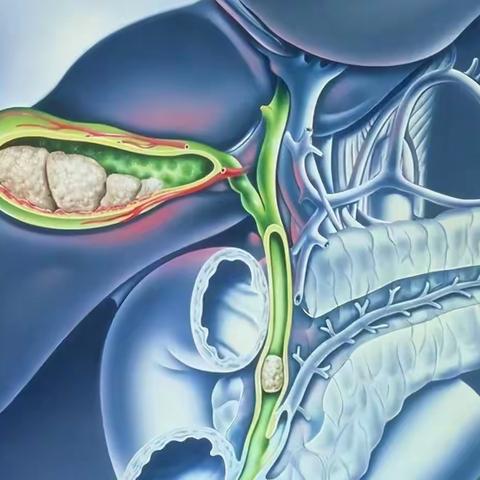 胆总管结石有“妙招”——腹腔镜下经胆囊管取石