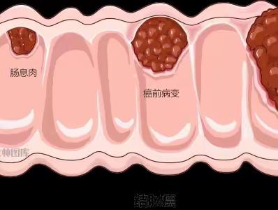 我叫息肉，是癌的近亲！