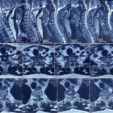 沉默的杀手 -- 椎管内病变病例分享