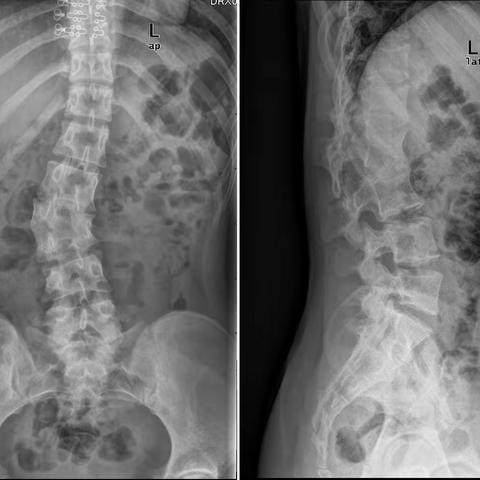 先天性脊柱侧弯畸形  L3椎体半椎体畸形 腰椎侧后突畸形