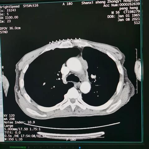 主动脉弓旁小细胞肺癌粒子植入术后纵隔血肿