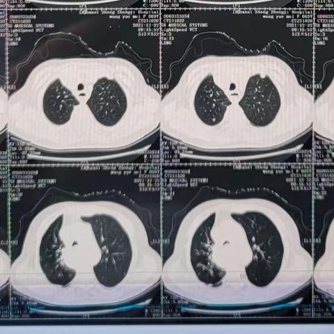 不一样的体位，相同的气管食道双支架植入