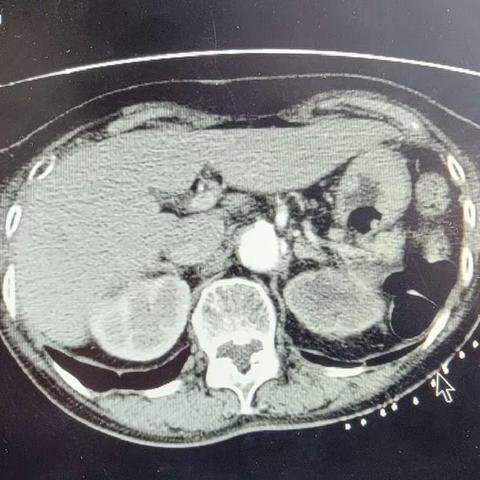 肾盂癌的放射性粒子植入治疗