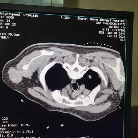 一例肺尖部结节的消融