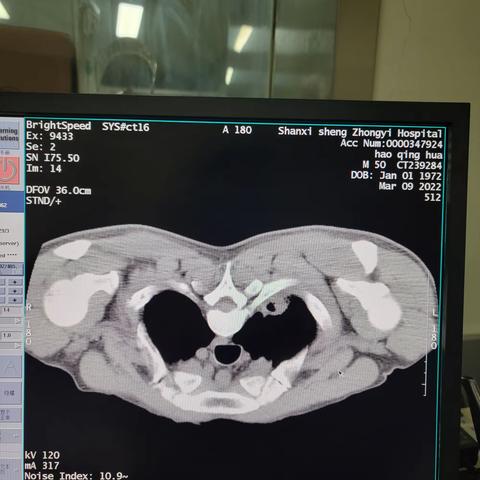肺尖部肿瘤穿刺一例