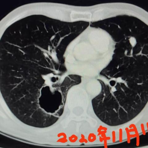 一例肺部空腔合并感染病例分享