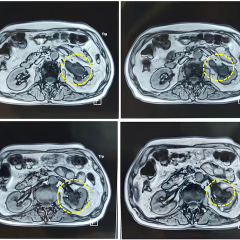 1例输尿管上皮癌的粒子条植入治疗病案分享