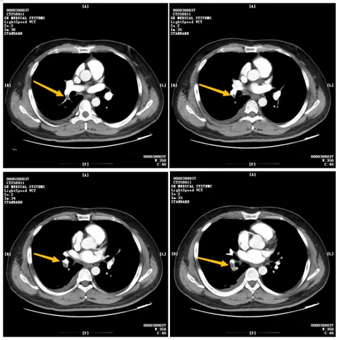 1例骑行事故导致肺栓塞患者的碎栓案例分享