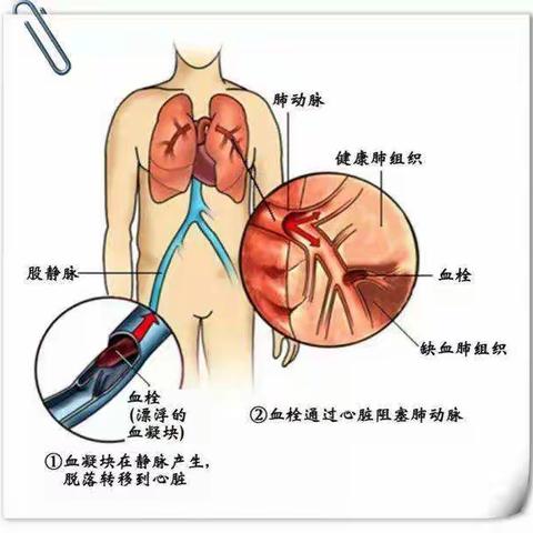 小科普：肺栓塞及其介入治疗