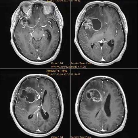 右侧额叶岛叶胶质母细胞瘤治疗