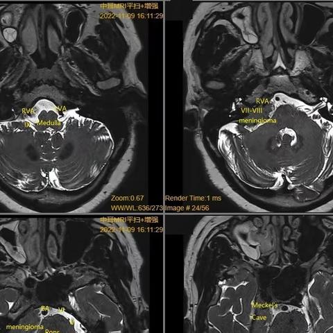 桥脑小脑角区（CPA）脑膜瘤手术治疗