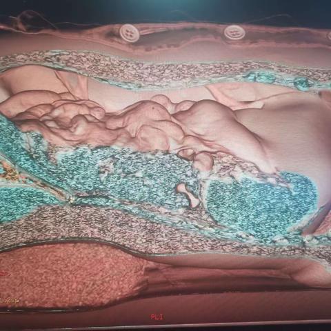 现代扁鹊慧眼——腹膜腔三维仿真成像