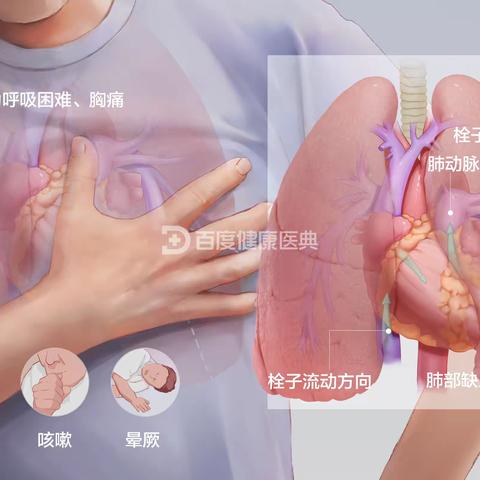 一例肺动脉栓塞成功介入救治汇报