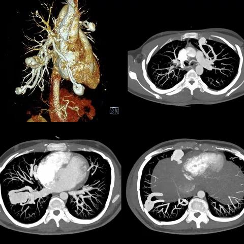 罕见双侧多发复杂性肺动静脉畸形