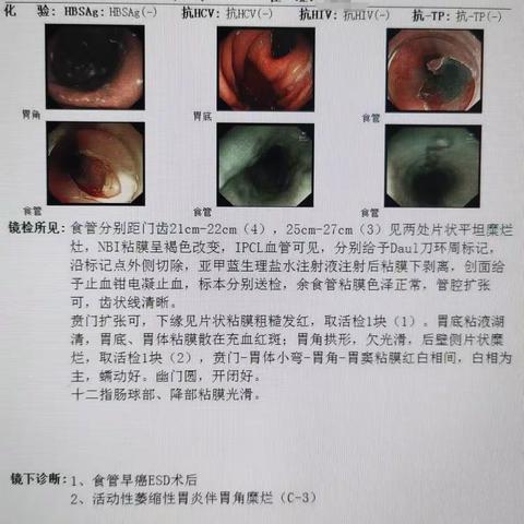夏邑县人民医院消化内科食管双发早癌一例总结
