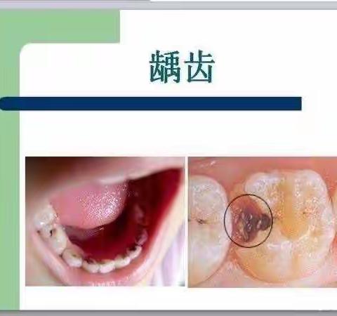 正安县机关幼儿园  幼儿园龋齿预防宣传——《关爱牙齿，预防龋齿》