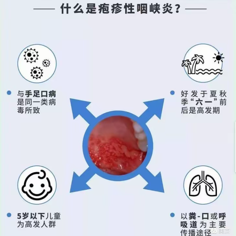 疱症性咽峡炎小知识