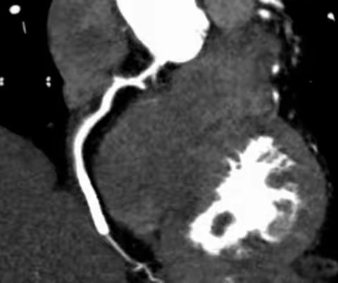 无限制单心跳冠脉CTA