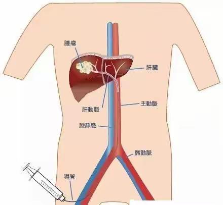 五分钟，涨点小知识（TACE术）