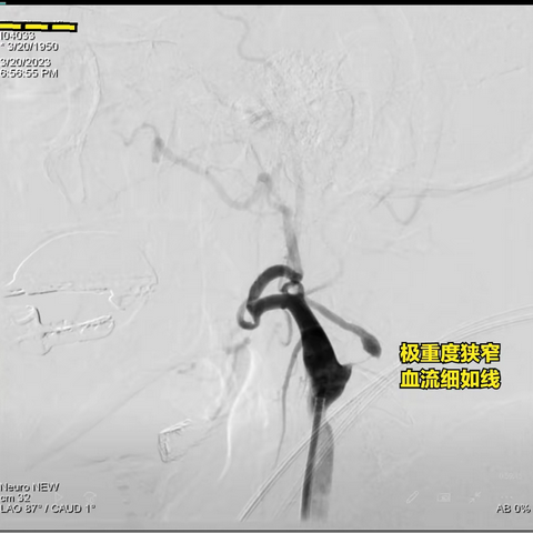 济“命悬一线”，启“生命坦途”——一例颈动脉极重度狭窄的救治