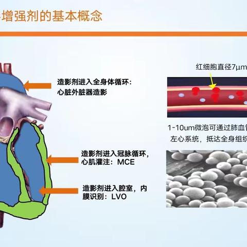 心脏超声再添新技术---左心声学造影