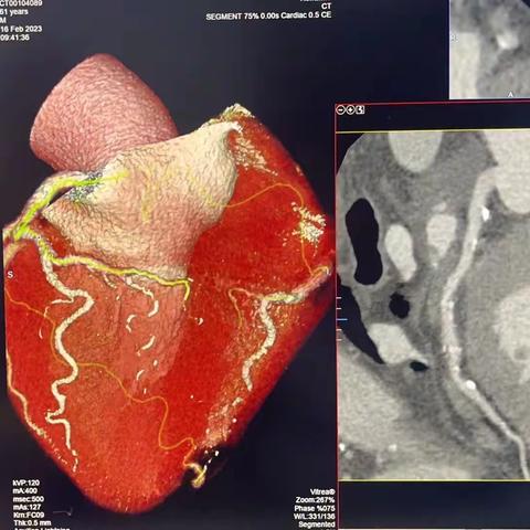 放射科成功开展冠状动脉CTA技术
