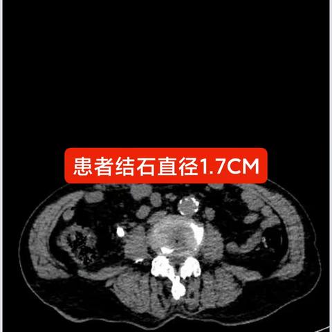 小结石大文章