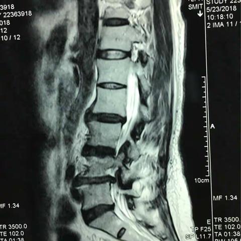 腰4腰5椎间盘脱出的经椎间孔髓核摘除术