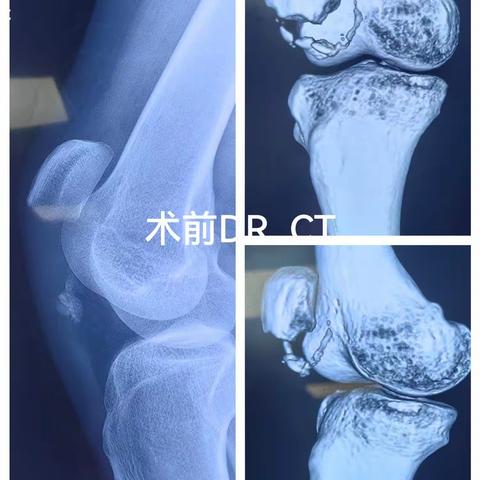 髌骨下极粉碎性撕脱骨折的"改良鬼脸固定术″