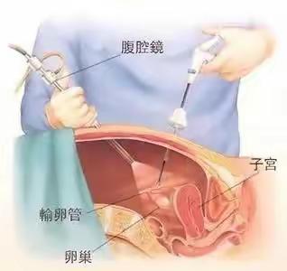 【健康贴士】腹腔镜手术注意事项