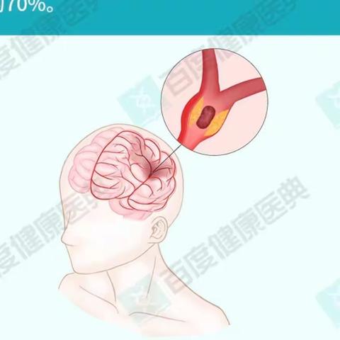 脑梗死治疗与预防