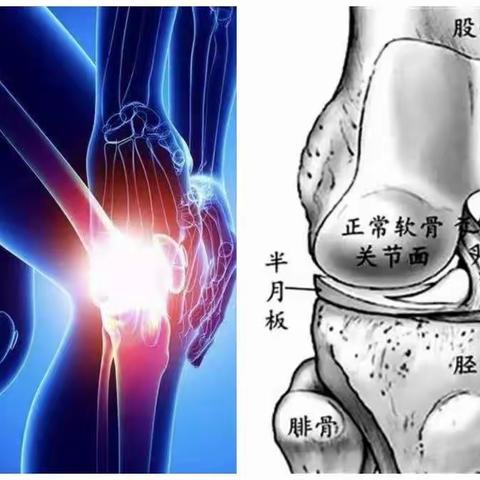 膝骨性关节炎---自我保健