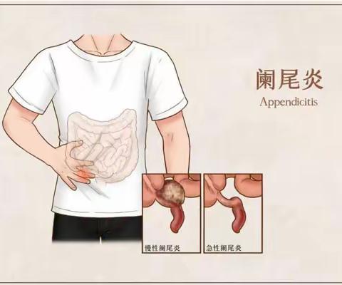 阑尾炎的症状及预防都有哪些？