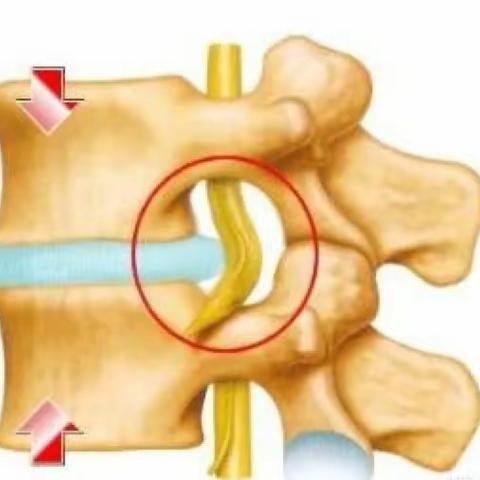椎间盘为什么会突出？