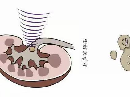 友松医院体外超声波碎石小科普