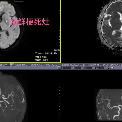 急性脑梗又逢心悸、胸痛，阵发性房颤如何快速复律，经食管心脏调搏值得关注