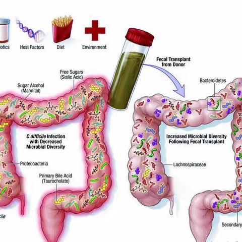 菌群移植方式