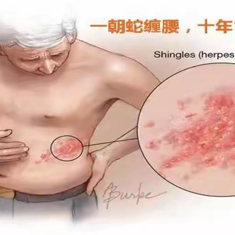 让长辈远离“切肤之痛”，带状疱疹疫苗可以预约接种啦！