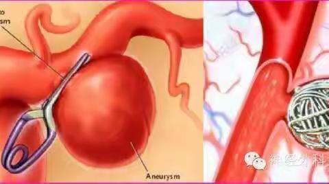 颅内动脉瘤