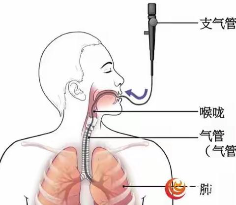 呼吸科首例非HIV耶氏肺孢子菌肺炎的发现