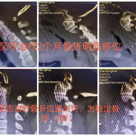 因病施治上颈椎，团队协作显神威