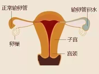 输卵管积水对胚胎有毒害，看看你有吗？